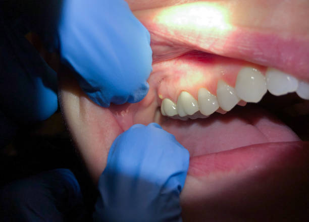Best Emergency Wisdom Teeth Removal in Piperton, TN